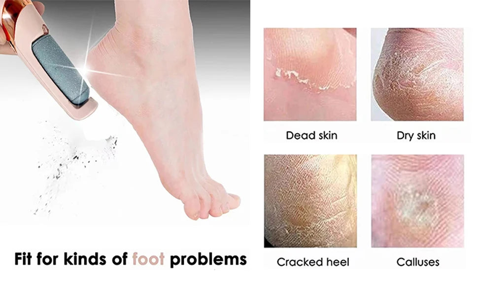 HoTo™ Callus Remover